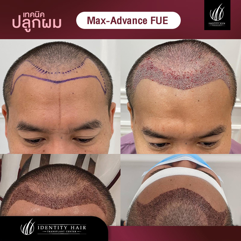 FUE-Review2